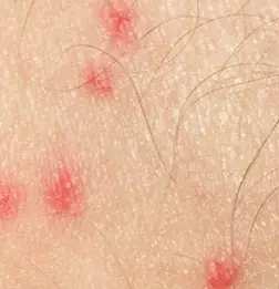 how to get rid of mosquito bites