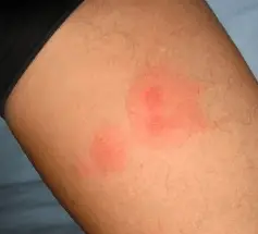 Mosquito bite allergic reactions