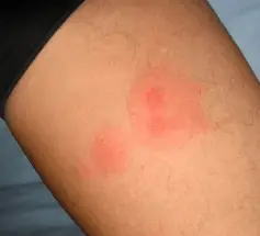 Mosquito bite allergy – Symptoms and Allergic Reaction to Mosquito