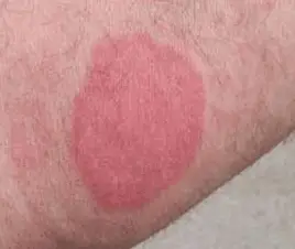 Mosquito bite allergy reactions