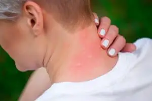 why do mosquito bites itch and swell