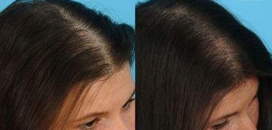 Egg Yolk for Hair - Growth, Mask, Loss, Thickening ...