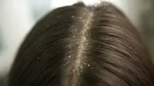 causes of dandruff in hair and eybrows