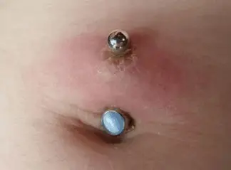 infected navel piercing