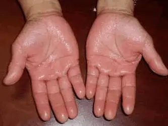 sweaty hands
