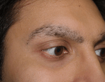 Eyebrow falling out male