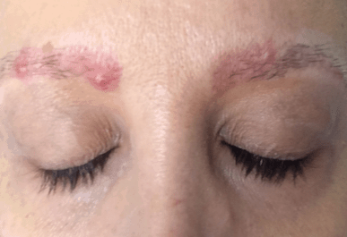Pimple On Eyebrow Causing Swelling