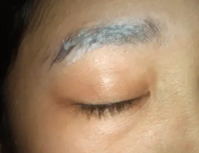 Dandruff in eyebrow causes
