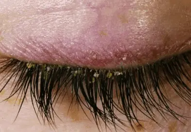 Causes of dandruff in eyelashes