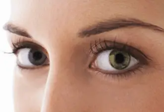 Laser procedure to change eye color