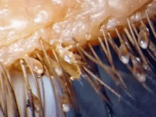 Eyelash mites in human