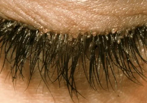 Eyelash mites causes