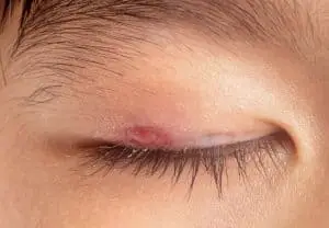 Ingrown Eyelash