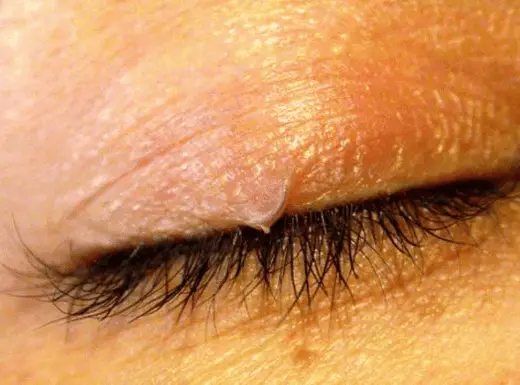 Ingrown eyelash