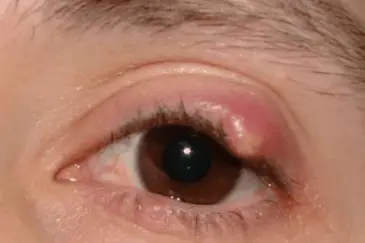 Ingrown eyelash hair symptoms