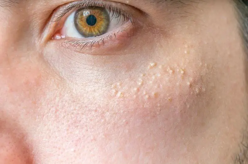 White Spots On Skin And How To Get Rid Of It
