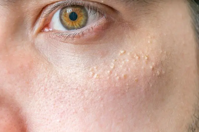 white-spots-on-skin-from-sun-exposure-how-to-prevent-treat