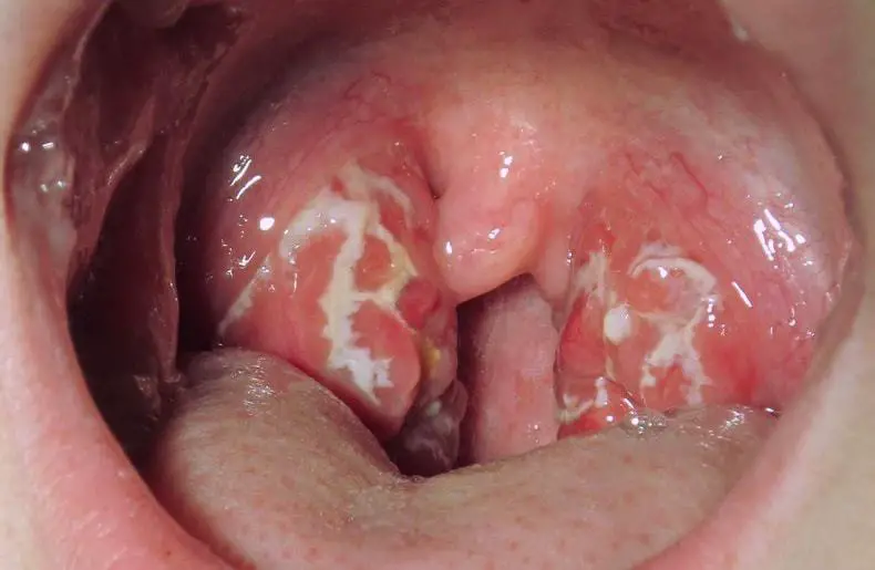 White Spots on Throat