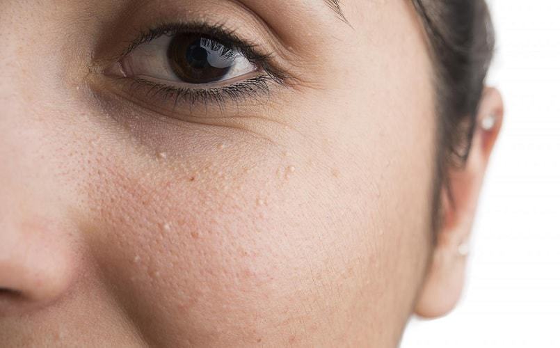 White Spots On Face Causes Under Eye Fungus Symptoms Pictures Not 