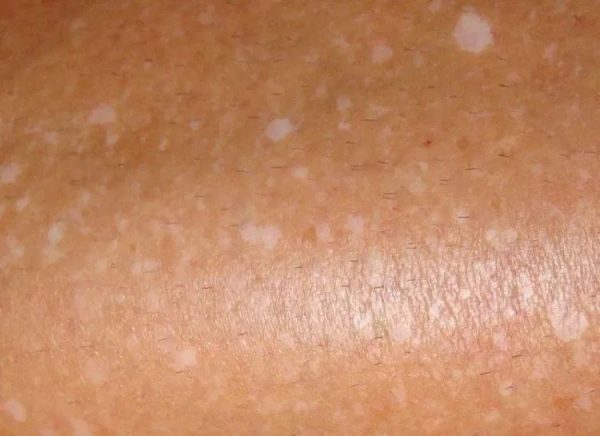 white-spots-on-legs-and-some-basic-remedies