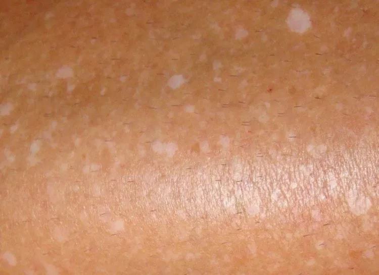 Download White Spots on Legs, Dry Spots, Itchy, Blood Circulation ...