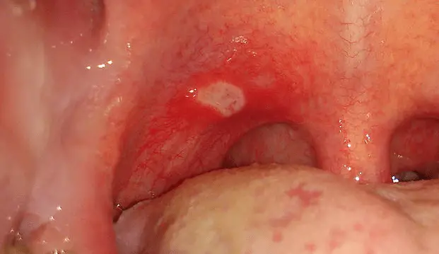 picture one white spot on the tonsil