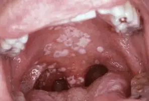 picture white spots on back of tonsils