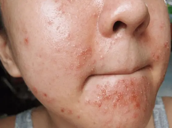 spots on the cheeks