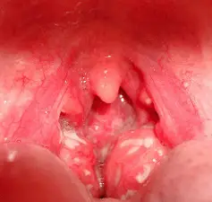 swollen tonsils