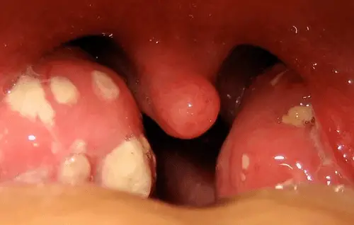 white dots on tonsils