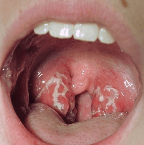 picture white spots on back of tonsils