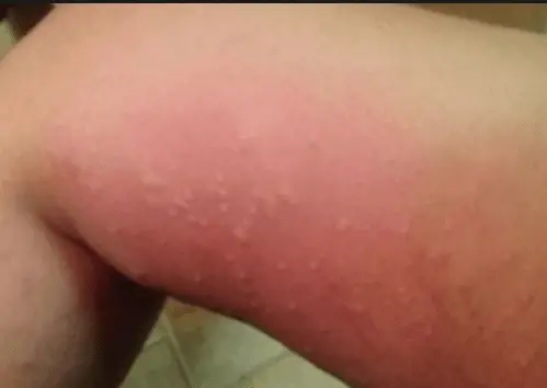 white spots on thigh
