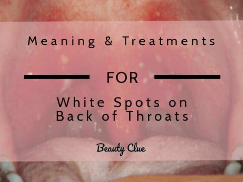 white spots on back of throat, tonsil