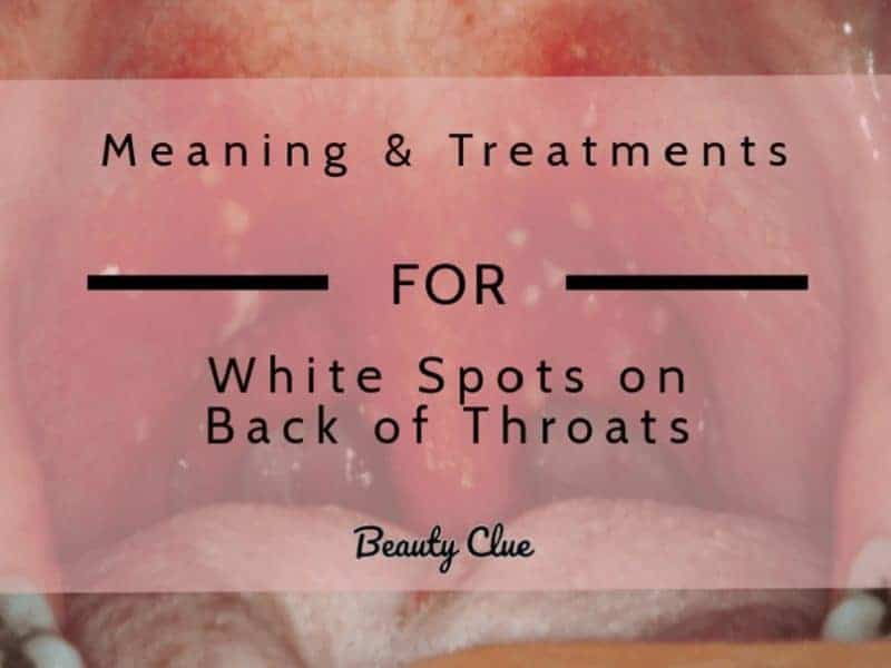 White Spots on the Throat with Pictures