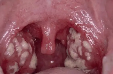 white spots on throat