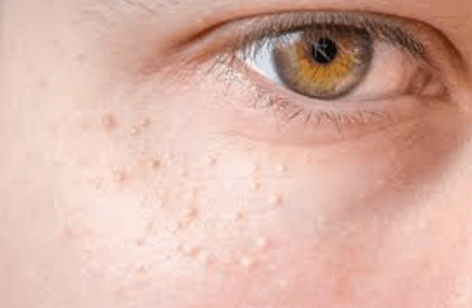 White Spots On Face Causes Under Eye Fungus Symptoms Pictures Not 