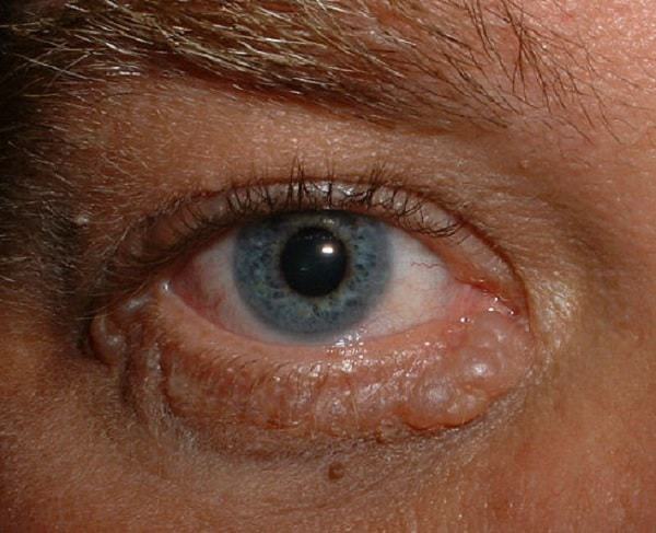 Sudoriferous Cyst on under eyelid