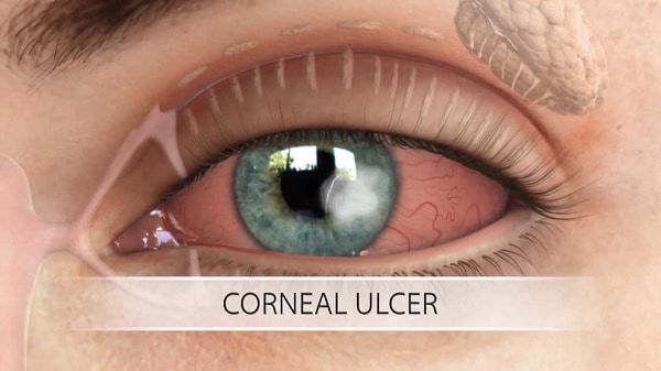 corneal ulcer on eyes