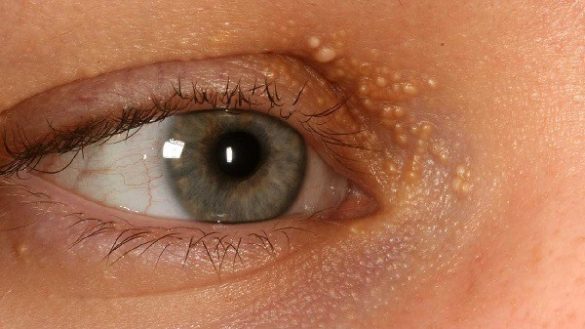 Different Types Of White Spots Under Eyelid And Home Remedies Treatment