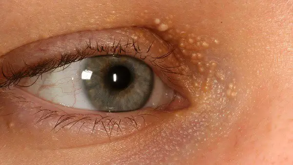 white spots on eyelids- milia