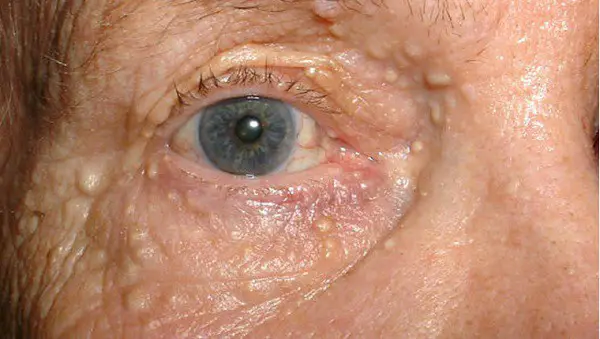 white dots on eyelids-syringoma
