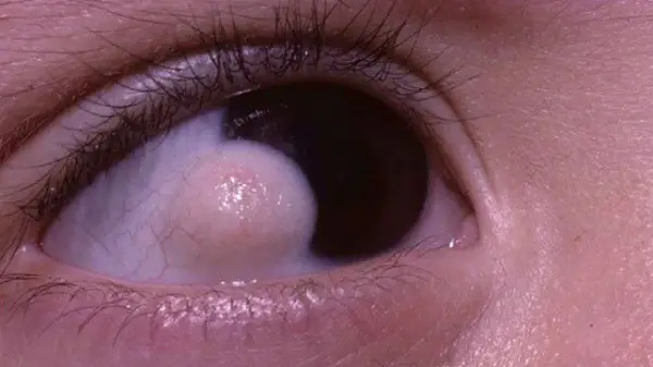 Pterygium- bumps on eyeball