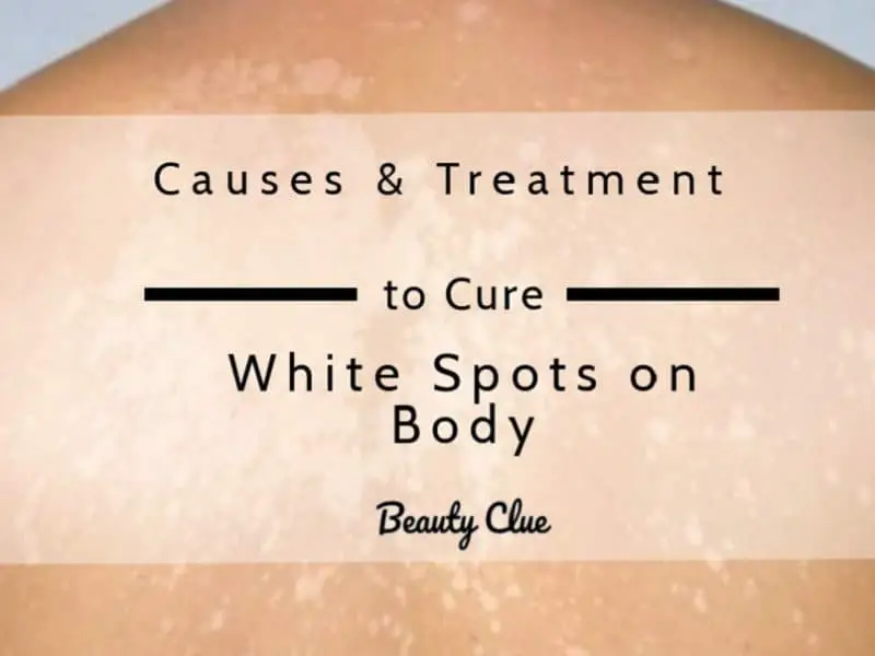 reasons and treatment of white spot on body