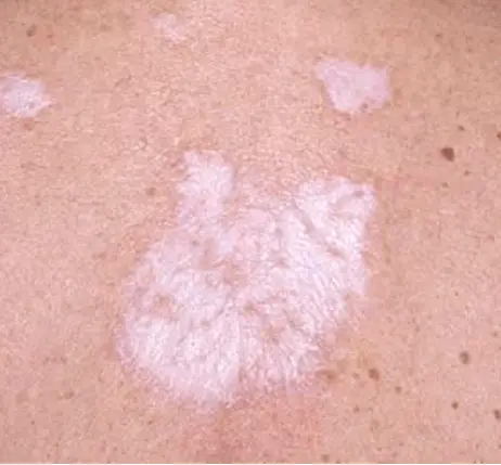 white spots on skin treatment
