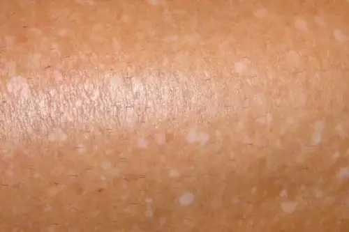 small white spots on skin