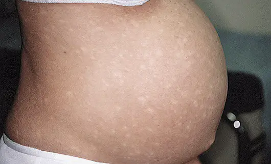 white spot on skin during pregnancy