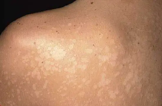 white spots on body