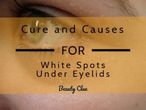 white lump on eyelids