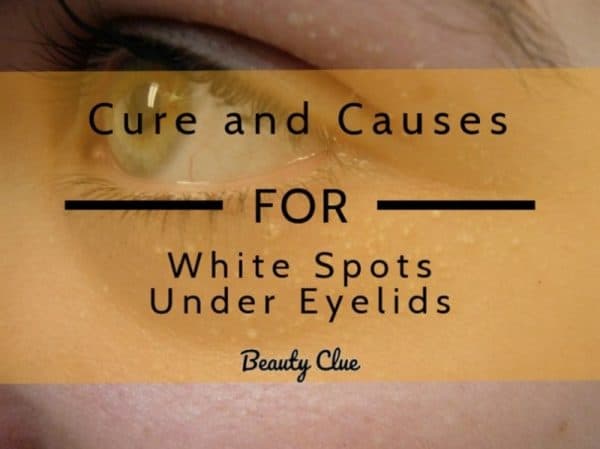 Different Types Of White Spots Under Eyelid And Home Remedies Treatment