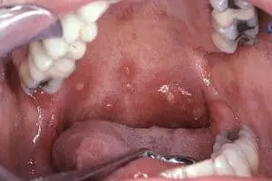 canker sore inside mouth deep